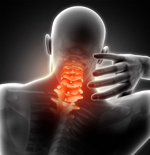 Cervical spondylosis