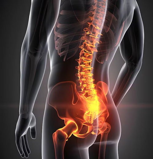 Sciatica