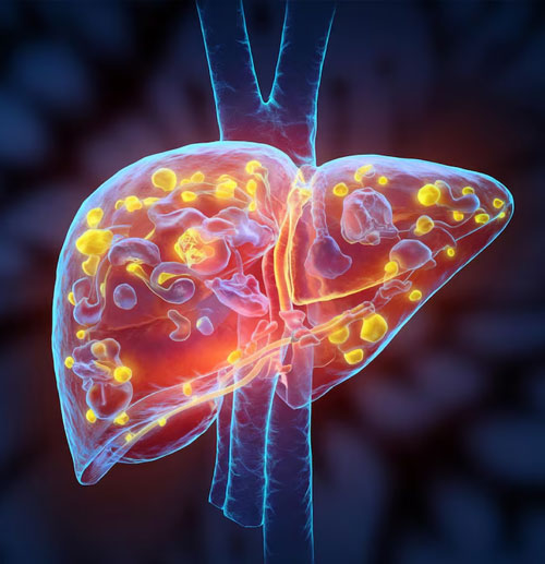 Fatty Liver
