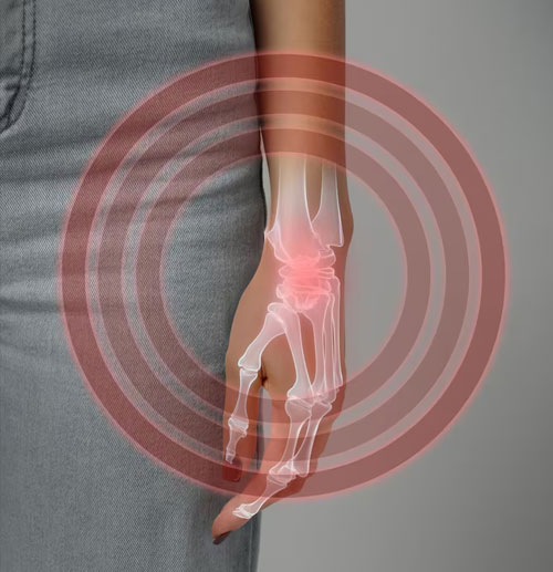 Carpel Tunnel Syndrome