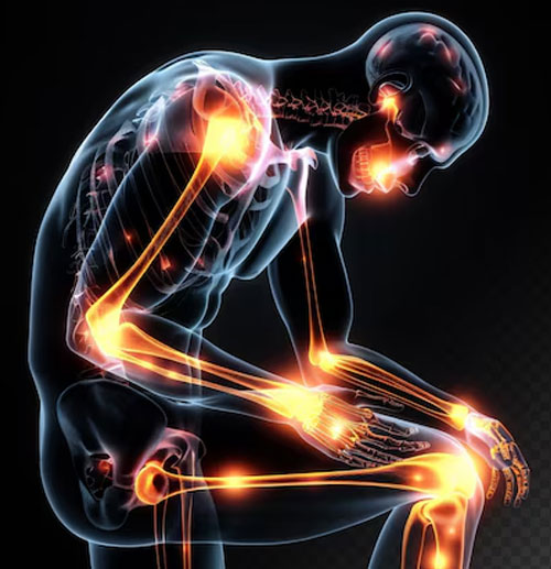 Fibromyalgia